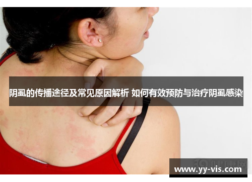 阴虱的传播途径及常见原因解析 如何有效预防与治疗阴虱感染